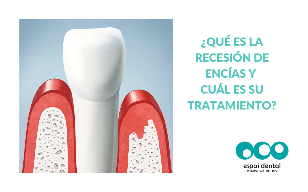 ¿QUÉ ES LA RECESIÓN DE ENCÍAS Y CUÁL ES SU TRATAMIENTO?